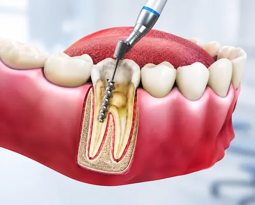 Root Canal Treatment at Twins Dental Clinic