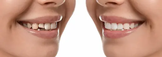 Smile Design at Twins Dental Clinic